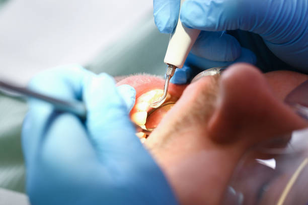 Best Emergency Tooth Extraction in Conestee, SC