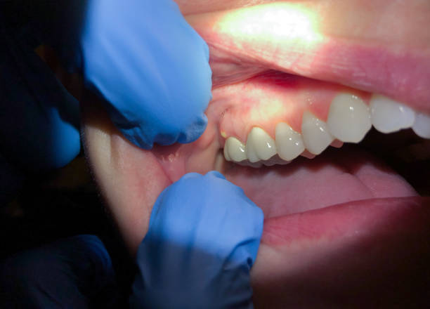 Best Emergency Treatment for Dental Infections or Abscesses in Conestee, SC